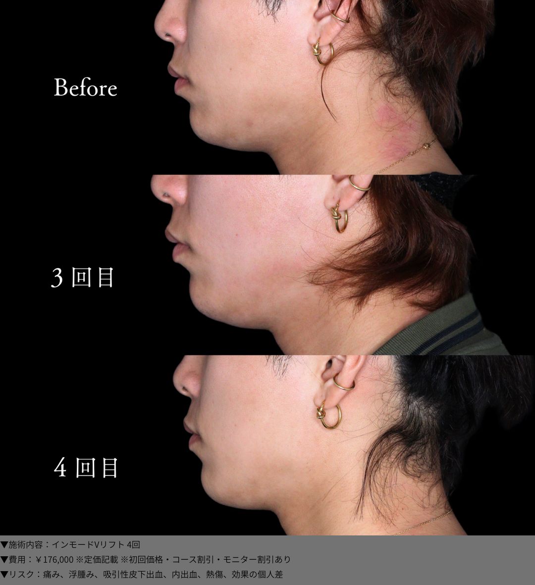 インモードVリフト 症例