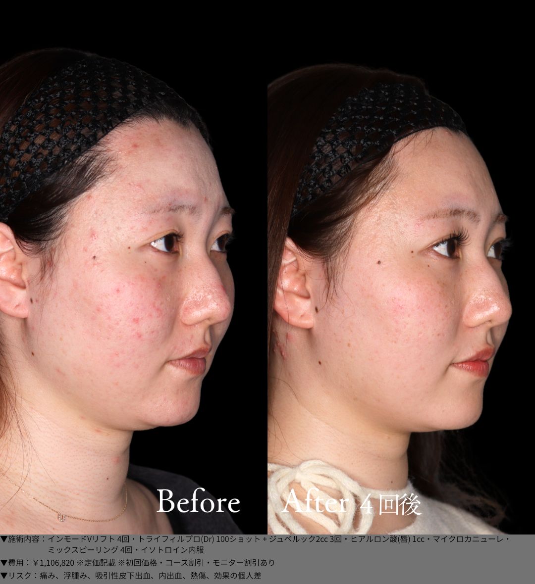 インモードVリフト トライフィルプロ ジュべルック ヒアルロン酸 マイクロカニューレ ミックスピーリング イソトロイン 症例