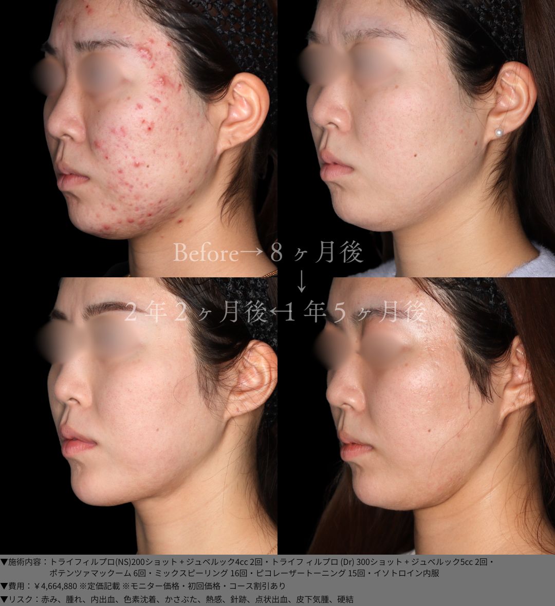 トライフィルプロ ジュべルック ポテンツァマックーム ミックスピーリング ピコレーザートーニング イソトロイン 症例