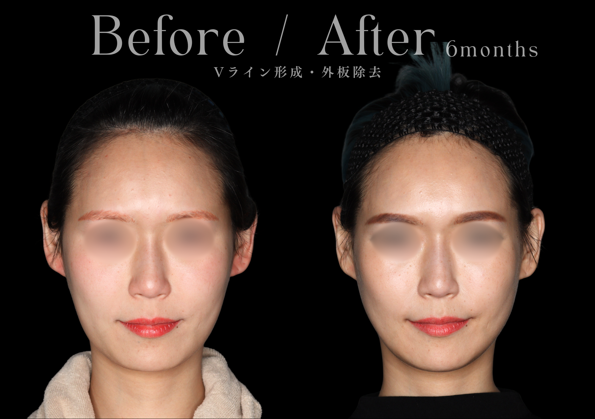 骨切り術による輪郭形成|本質的な小顔治療をお探しなら