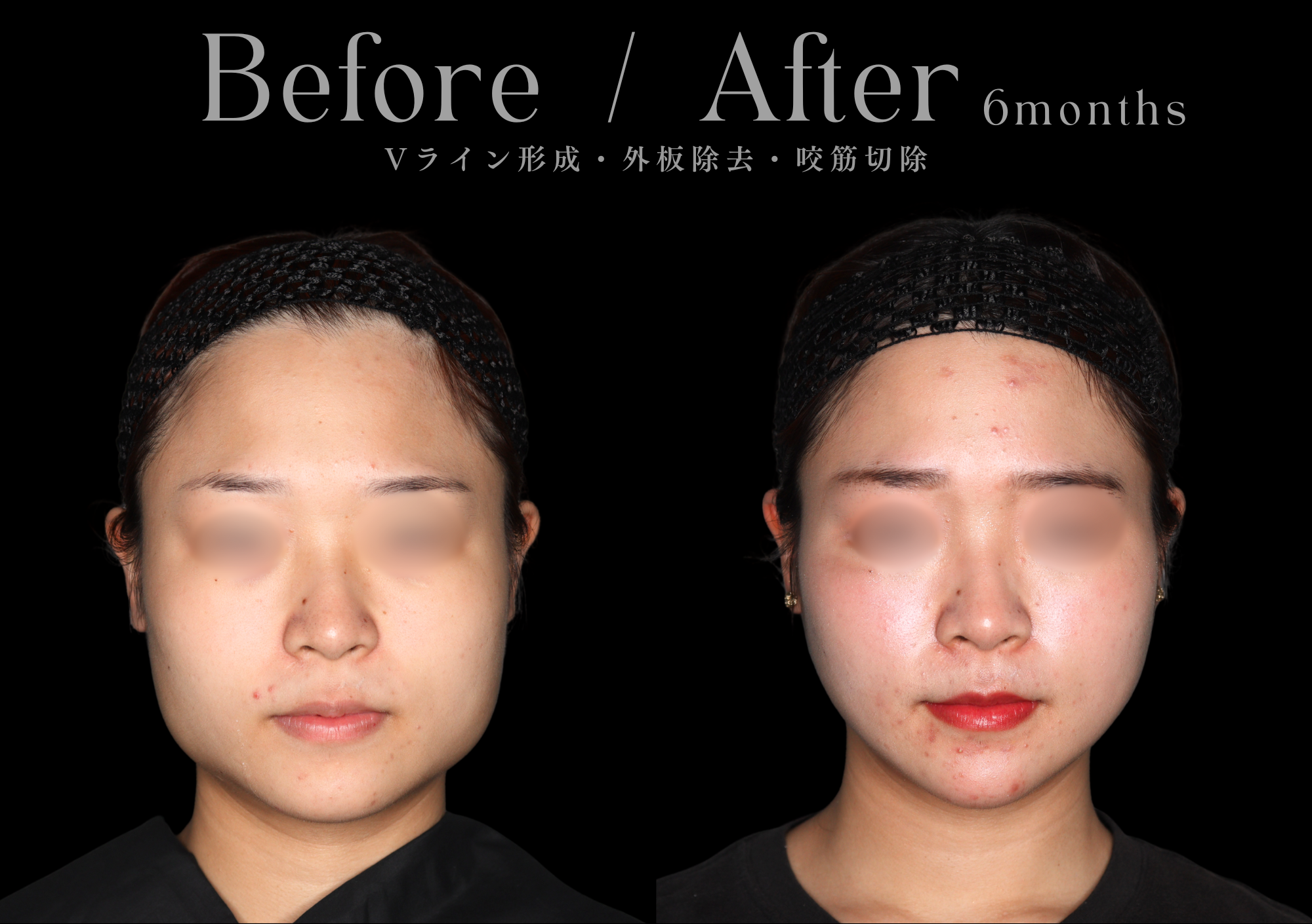 骨切り術による輪郭形成|本質的な小顔治療をお探しなら