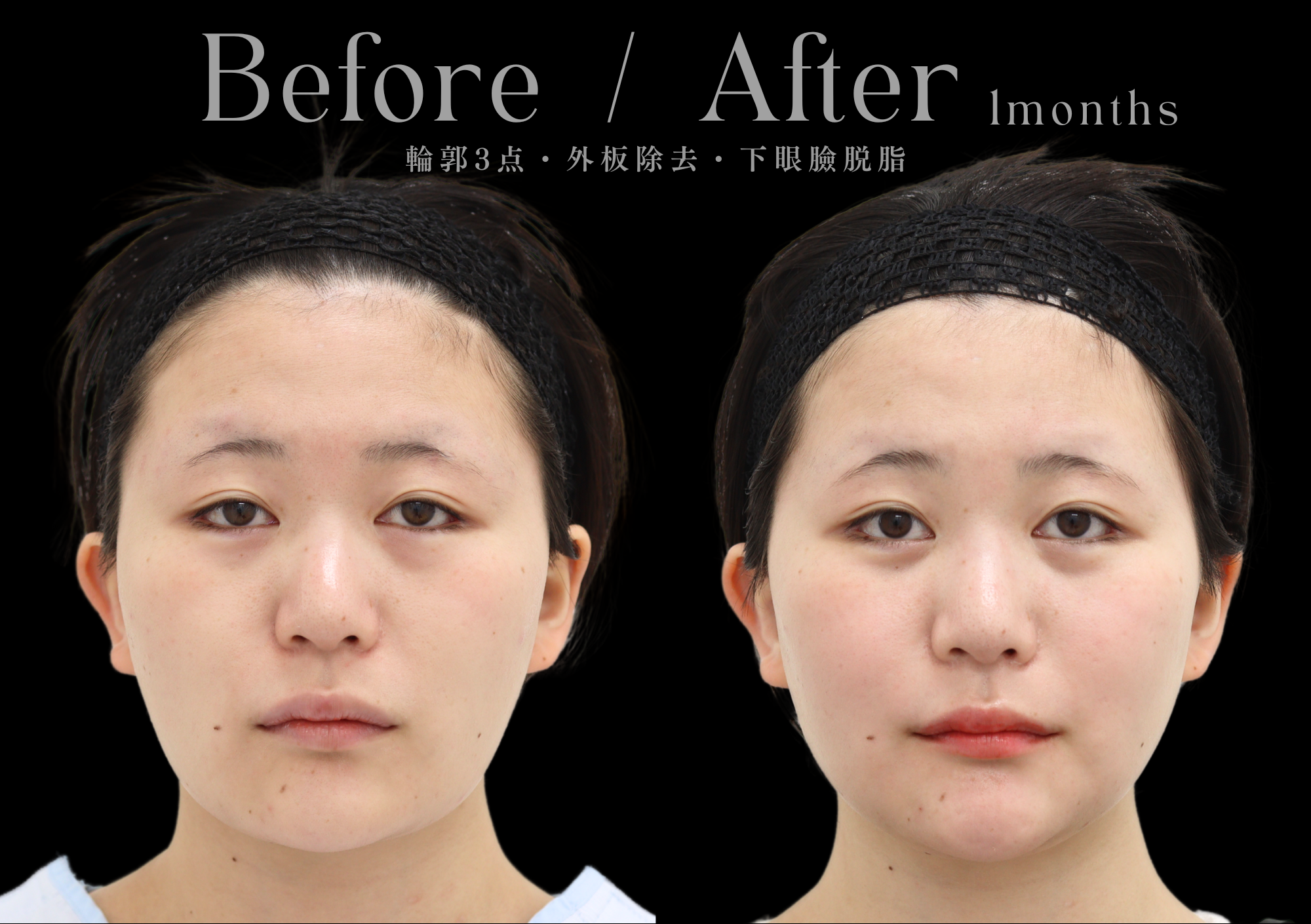 骨切り術による輪郭形成|本質的な小顔治療をお探しなら