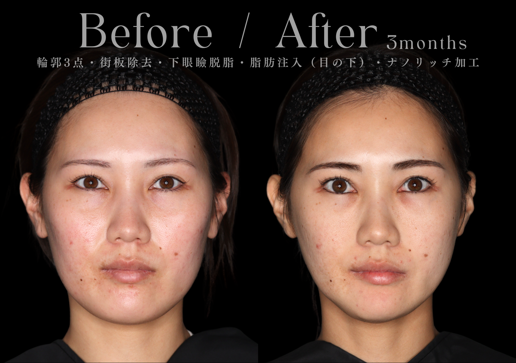 骨切り術による輪郭形成|本質的な小顔治療をお探しなら