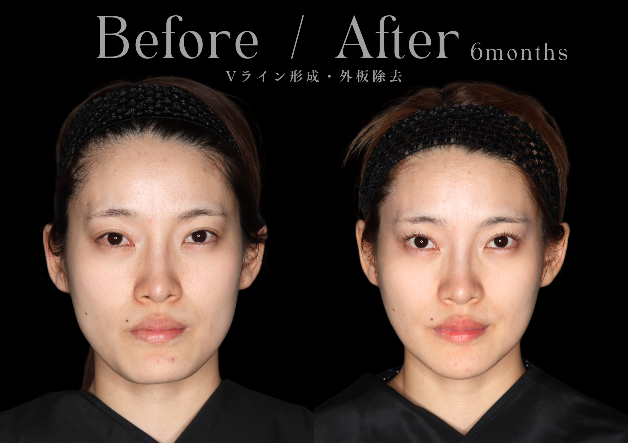 骨切り術による輪郭形成|本質的な小顔治療をお探しなら