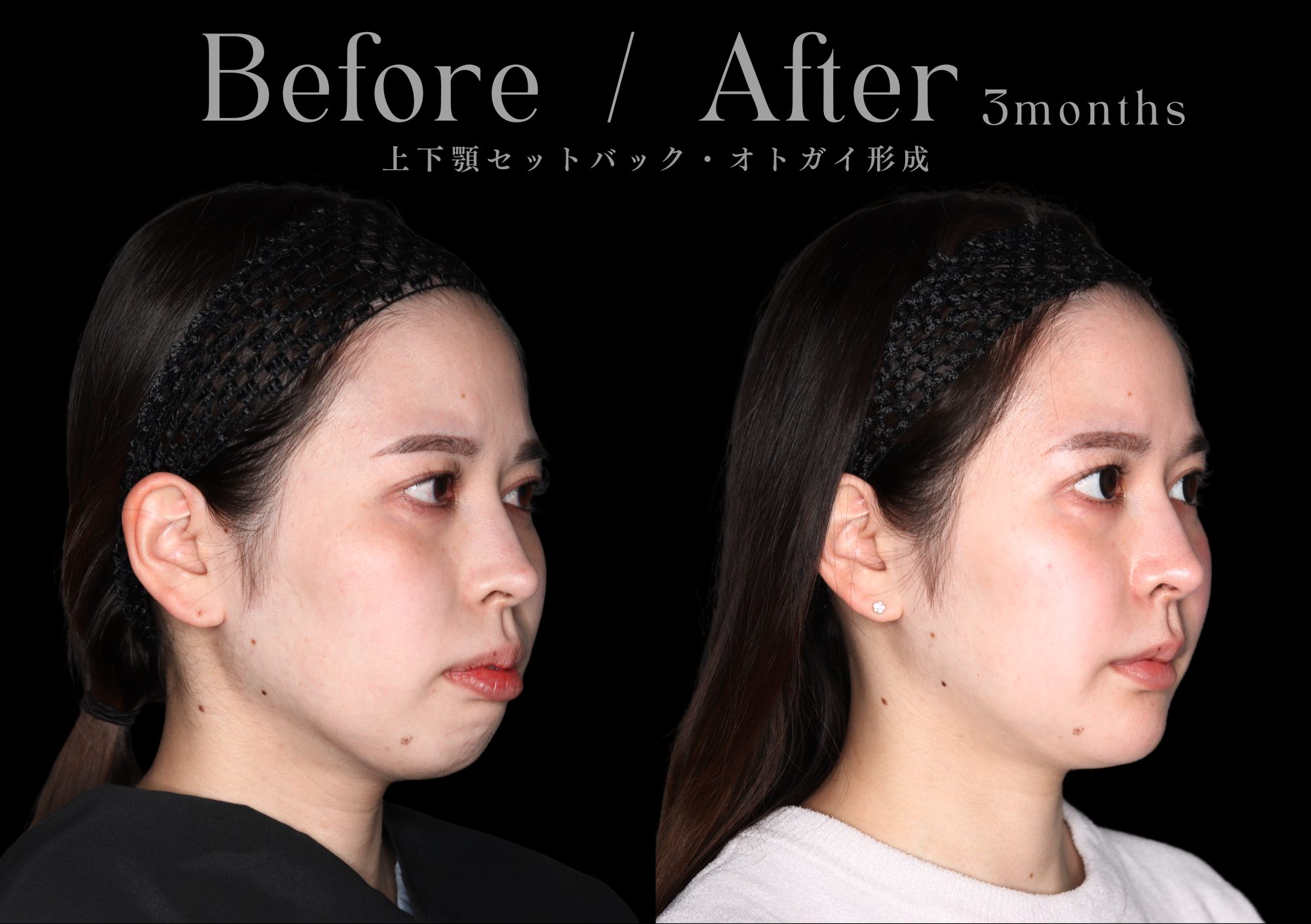 骨切り術による輪郭形成|本質的な小顔治療をお探しなら