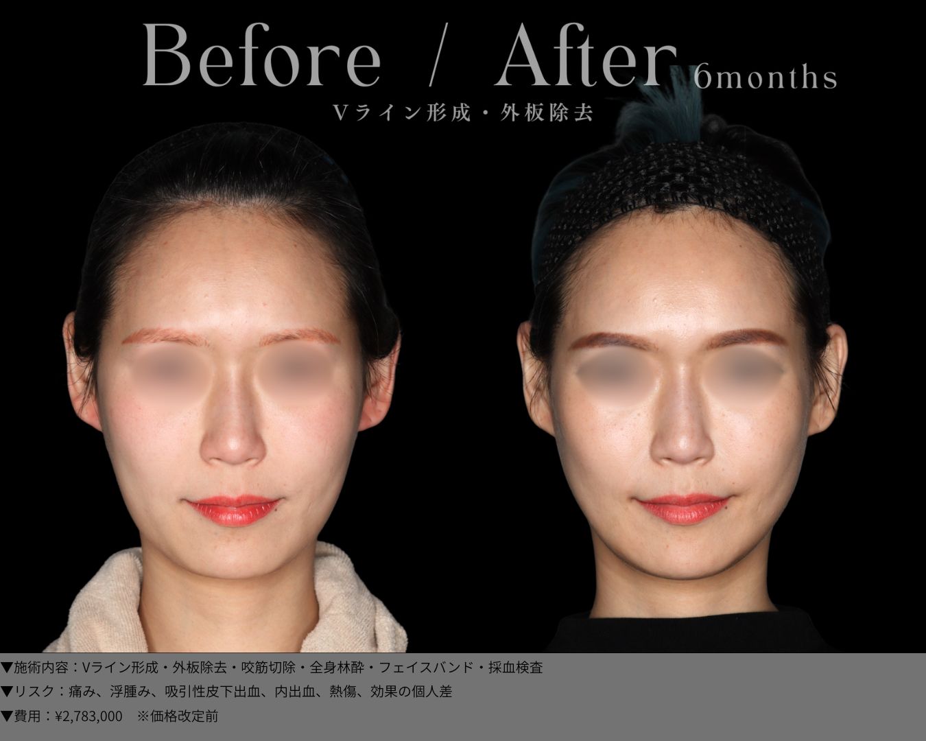 Vライン形成・外板除去・全身麻酔・採血検査・フィスバンド