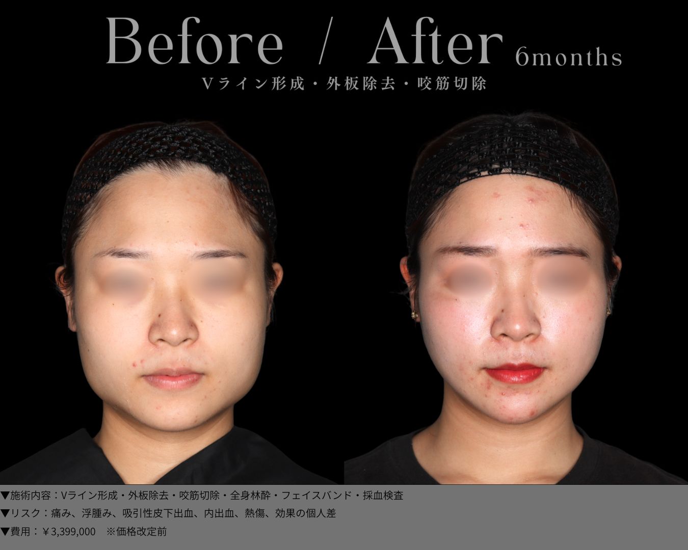 Vライン形成・外板除去・咬筋切除・全身林酔・フェイスバンド・採血検査