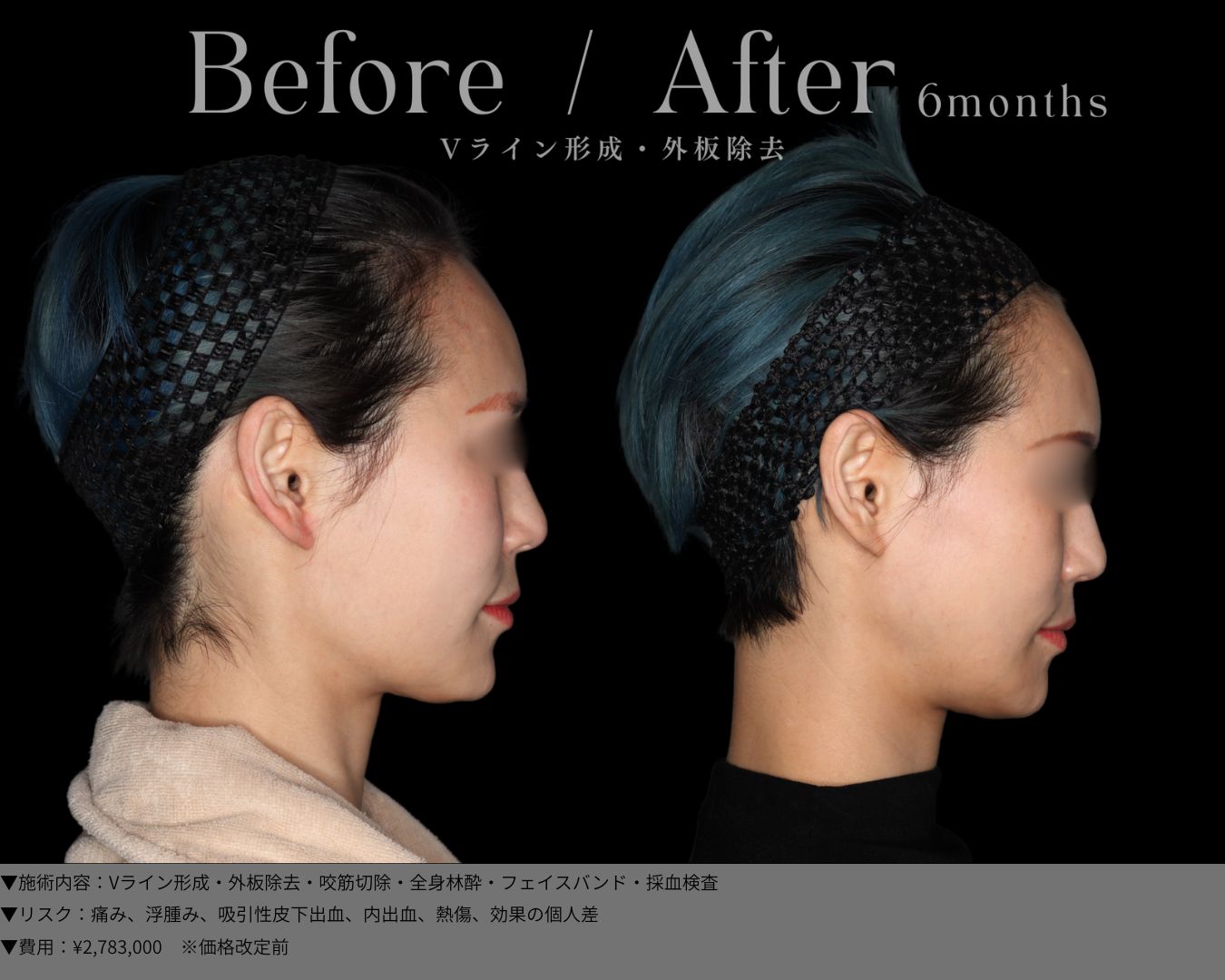 Vライン形成・外板除去・全身麻酔・採血検査・フィスバンド