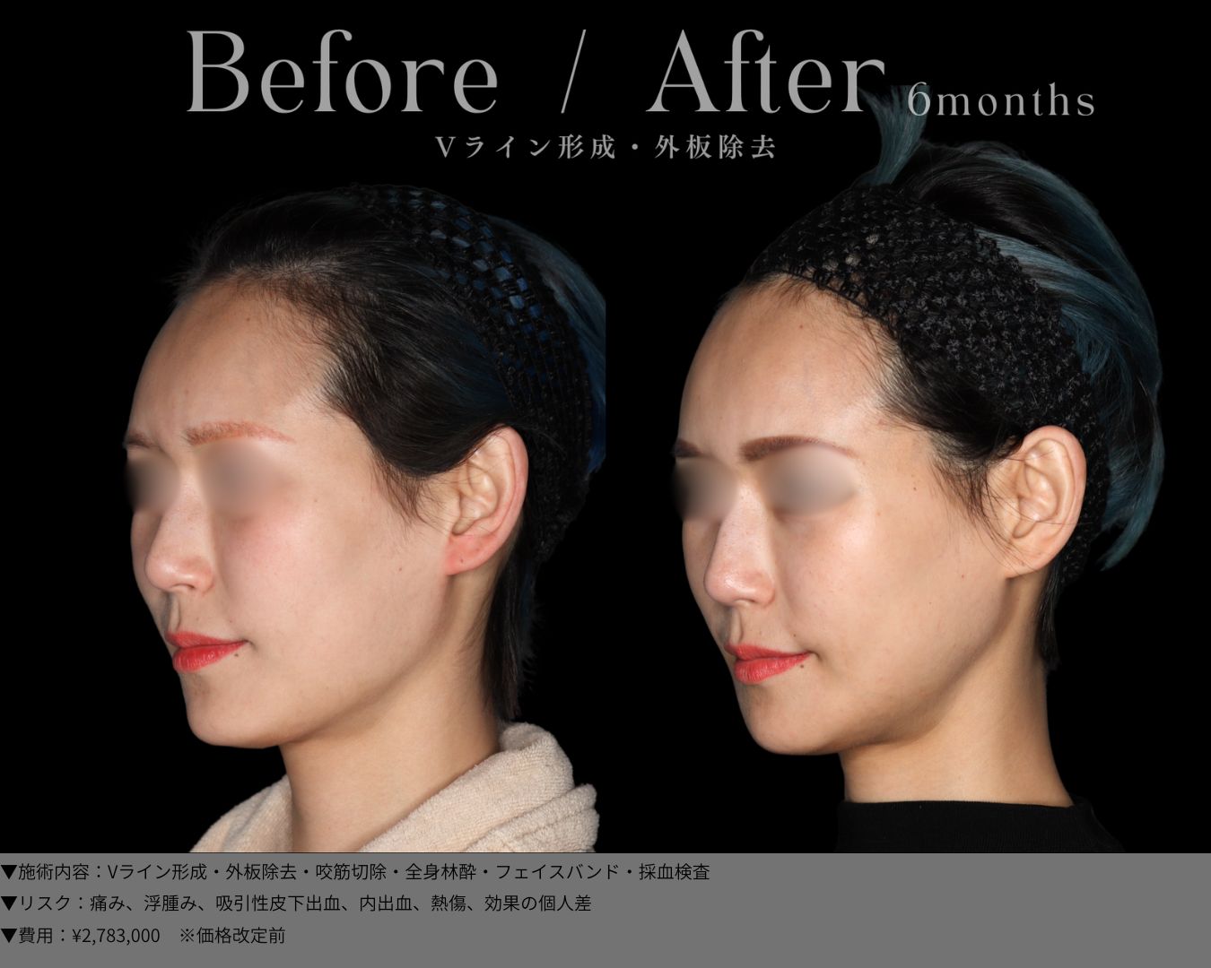 Vライン形成・外板除去・全身麻酔・採血検査・フィスバンド