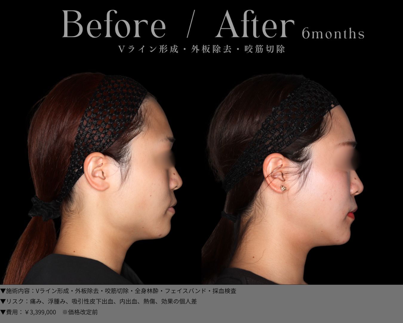 Vライン形成・外板除去・咬筋切除・全身林酔・フェイスバンド・採血検査