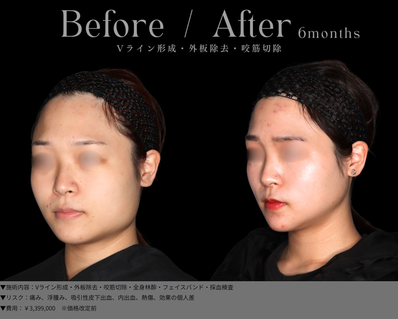 Vライン形成・外板除去・咬筋切除・全身林酔・フェイスバンド・採血検査