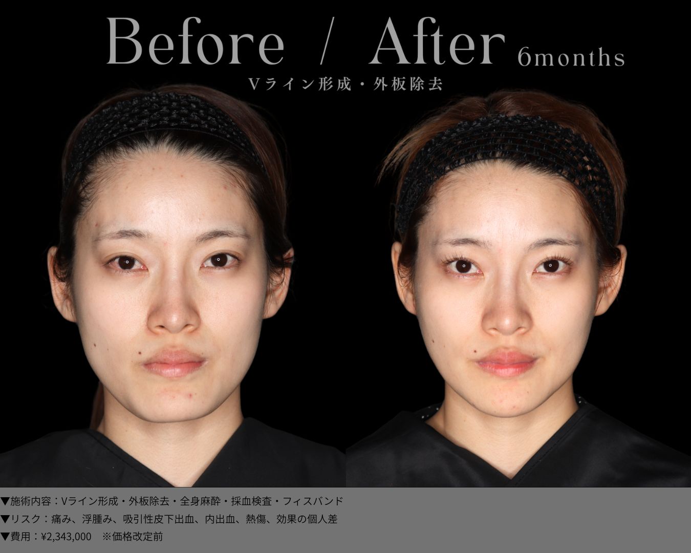 Vライン形成・外板除去・全身麻酔・採血検査・フィスバンド