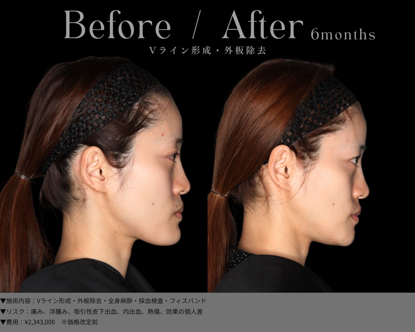 Vライン形成・外板除去・全身麻酔・採血検査・フィスバンド