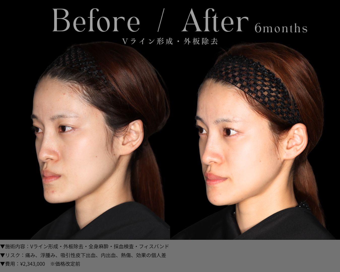 Vライン形成・外板除去・全身麻酔・採血検査・フィスバンド