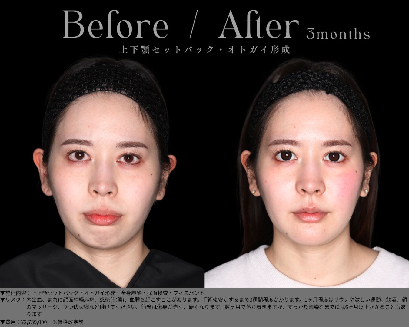 上下顎セットバック・オトガイ形成・全身麻酔・採血検査・フィスバンド