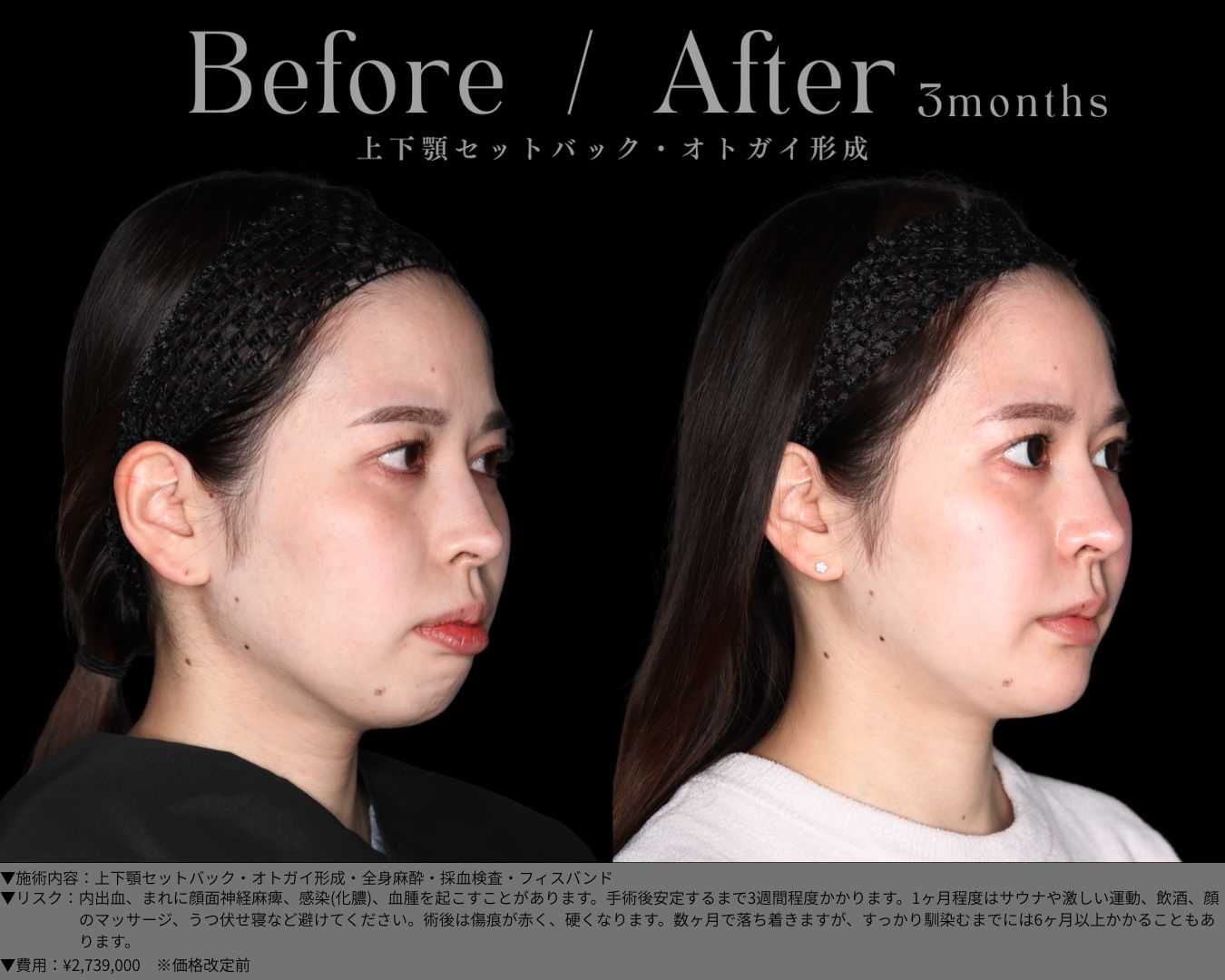 上下顎セットバック・オトガイ形成・全身麻酔・採血検査・フィスバンド