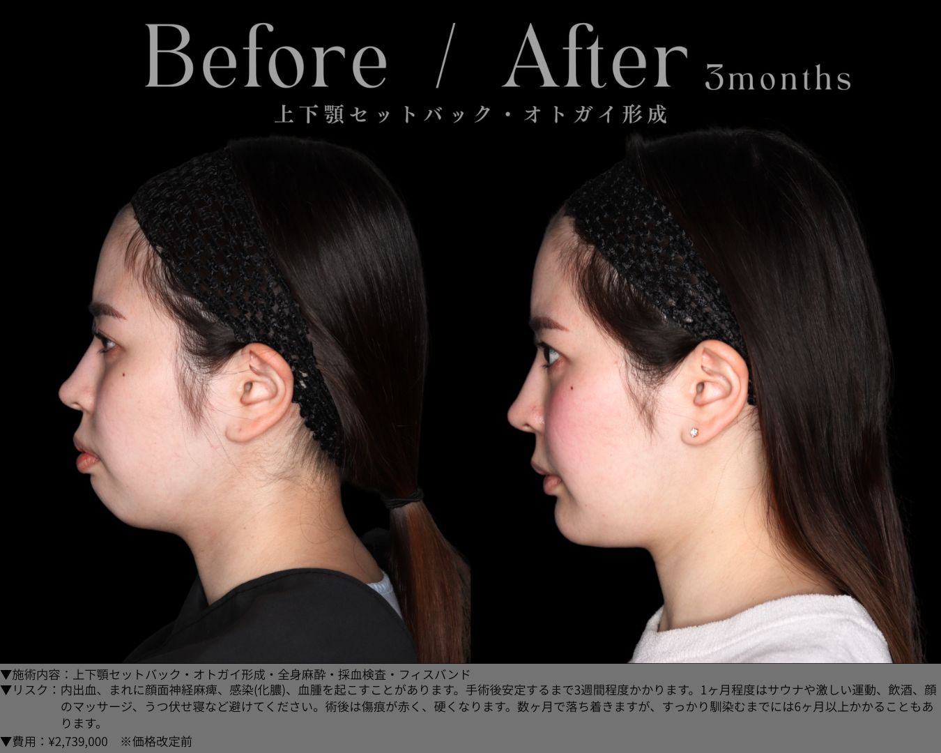 上下顎セットバック・オトガイ形成・全身麻酔・採血検査・フィスバンド