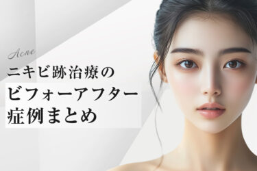 ニキビ跡治療のビフォーアフター症例まとめ