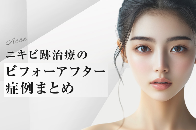 ニキビ跡 クレーター 治療 症例 ビフォーアフター