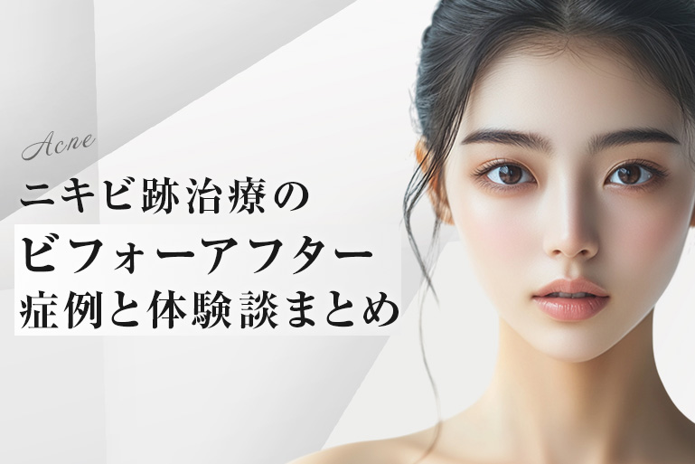 ニキビ跡治療症例ビフォーアフター