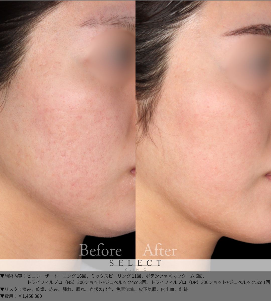 ピコレーザートーニング16回 ミックスピーリング11回 ポテンツァ×マックーム6回 トライフィルプロ（NS）200ショット＋ジュベルック4cc3回 トライフィルプロ（DR）300ショット＋ジュベルック5cc1回