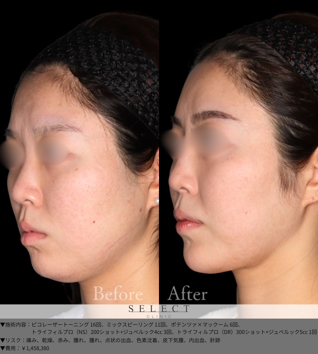 ピコレーザートーニング16回 ミックスピーリング11回 ポテンツァ×マックーム6回 トライフィルプロ（NS）200ショット＋ジュベルック4cc3回 トライフィルプロ（DR）300ショット＋ジュベルック5cc1回