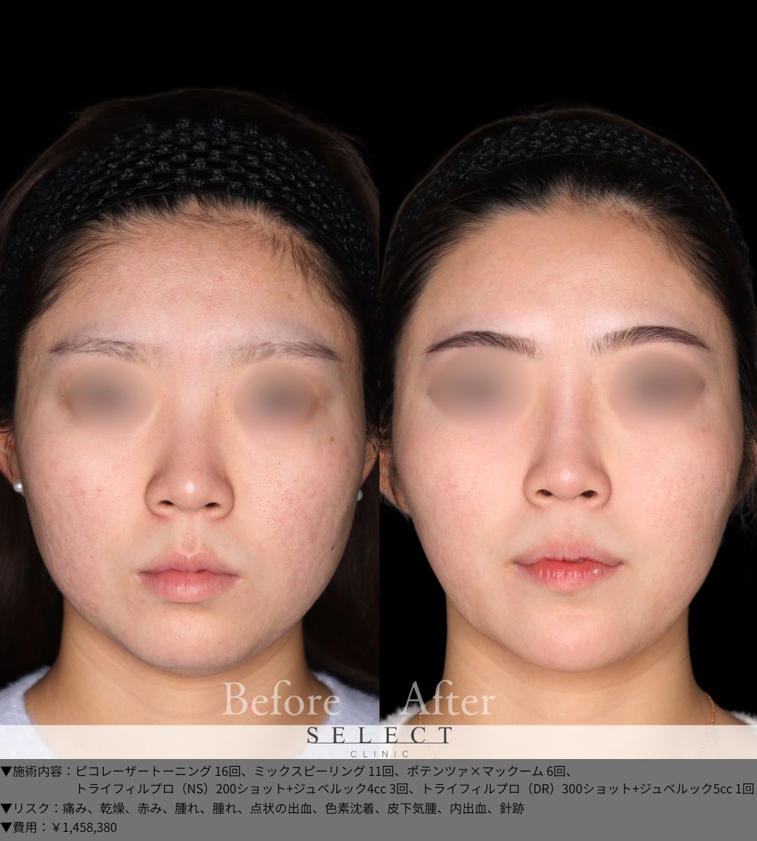 ピコレーザートーニング16回 ミックスピーリング11回 ポテンツァ×マックーム6回 トライフィルプロ（NS）200ショット＋ジュベルック4cc3回 トライフィルプロ（DR）300ショット＋ジュベルック5cc1回