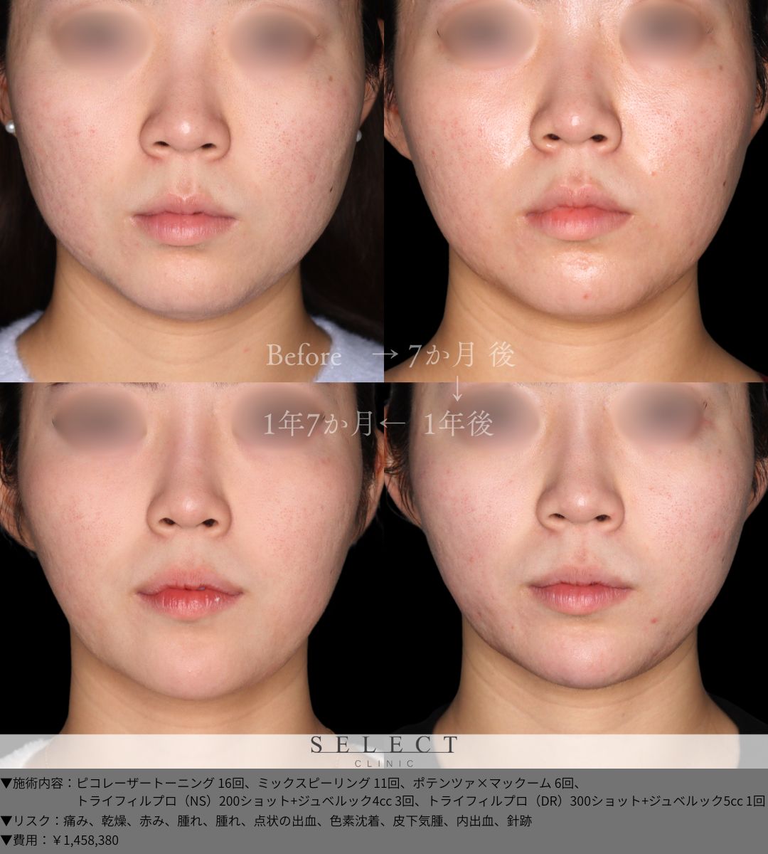 ピコレーザートーニング16回 ミックスピーリング11回 ポテンツァ×マックーム6回 トライフィルプロ（NS）200ショット＋ジュベルック4cc3回 トライフィルプロ（DR）300ショット＋ジュベルック5cc1回