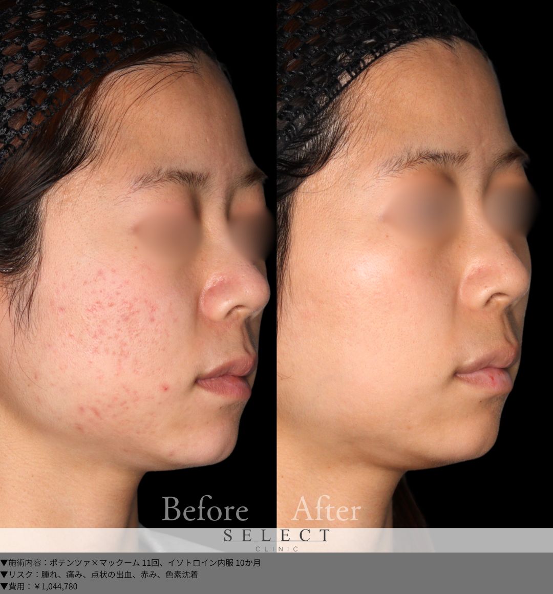 ポテンツァ×マックーム11回 イソトロイン内服10か月