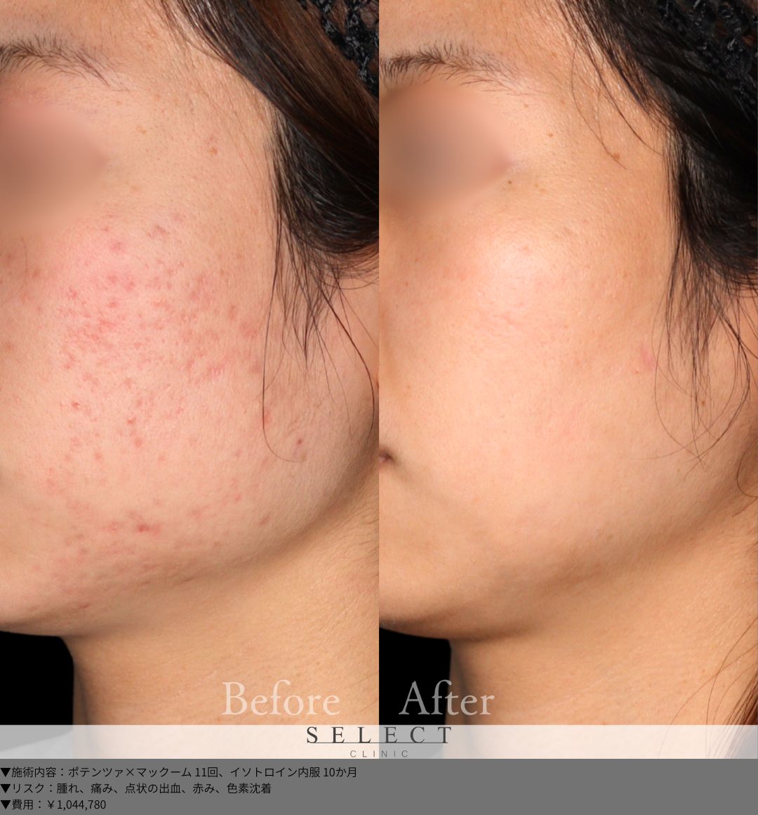 ポテンツァ×マックーム11回 イソトロイン内服10か月