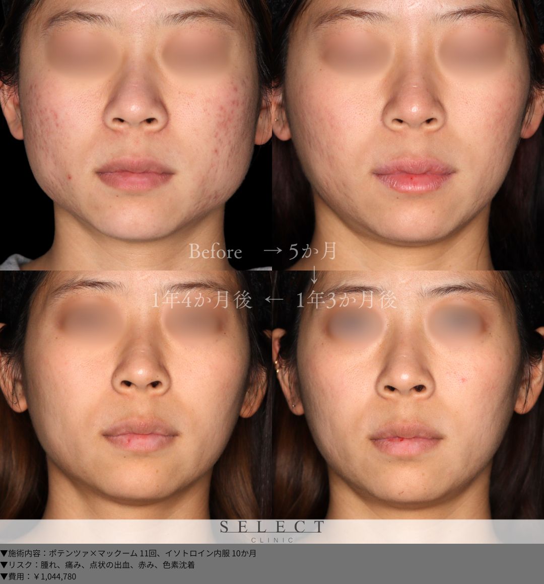 ポテンツァ×マックーム11回 イソトロイン内服10か月