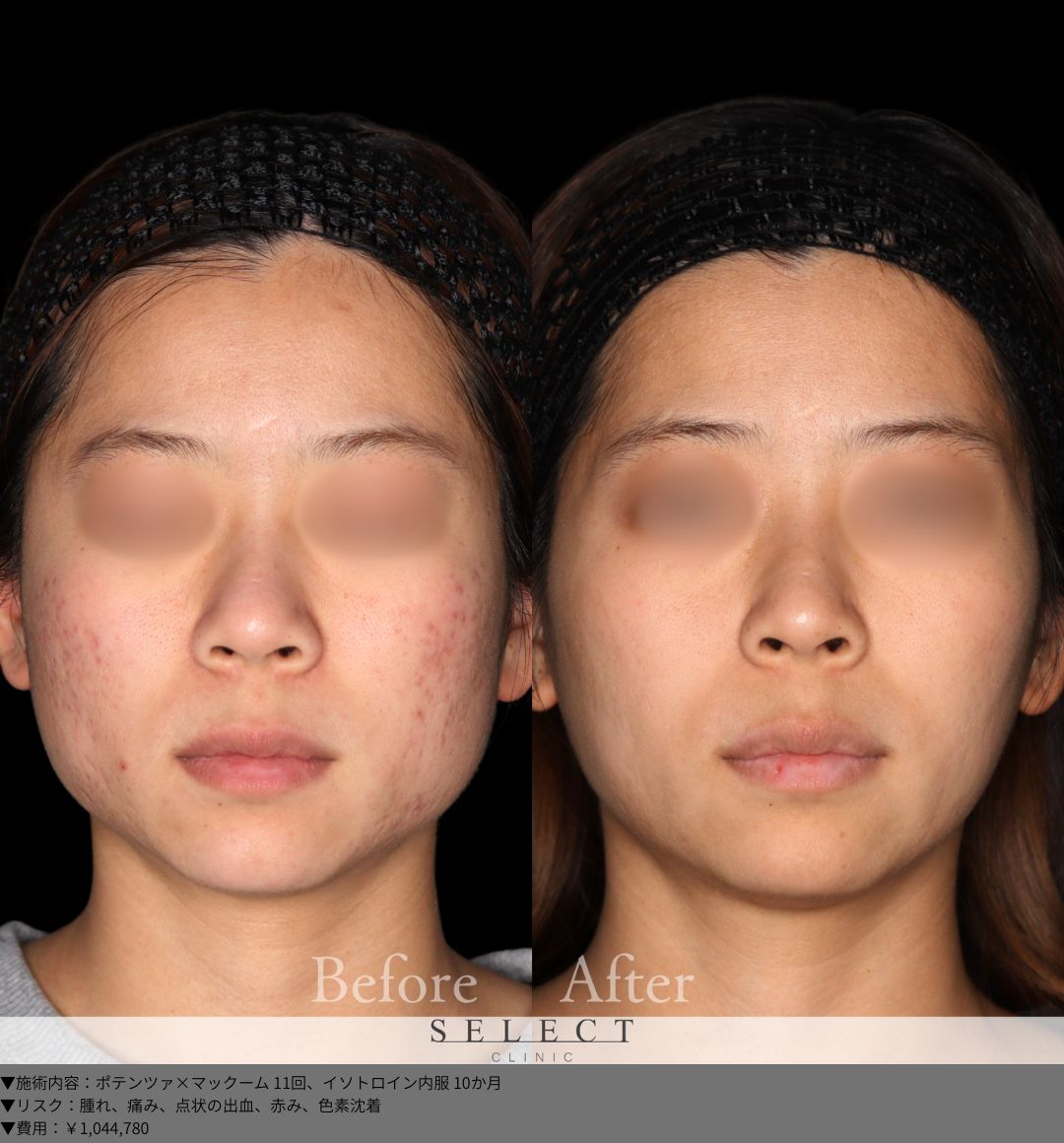 ポテンツァ×マックーム11回 イソトロイン内服10か月