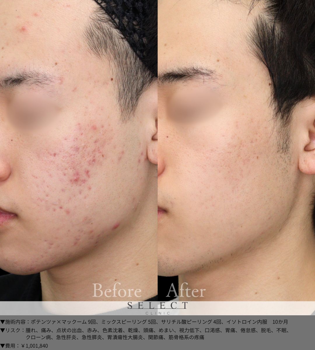 ポテンツァ×マックーム9回 ミックスピーリング5回 サリチル酸ピーリング4回 イソトロイン内服　10か月