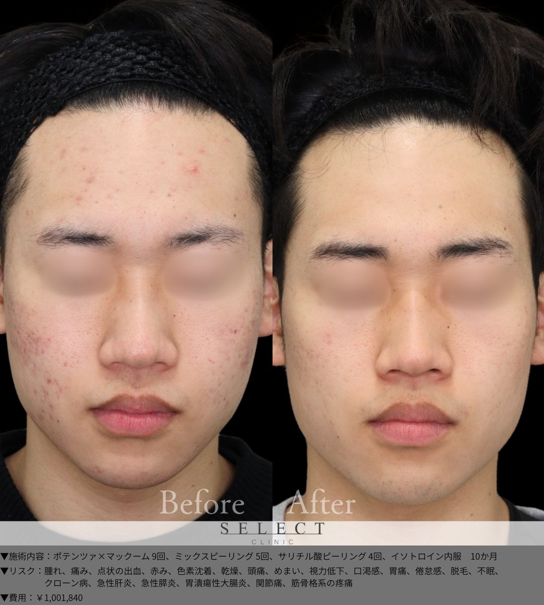 ポテンツァ×マックーム9回 ミックスピーリング5回 サリチル酸ピーリング4回 イソトロイン内服　10か月