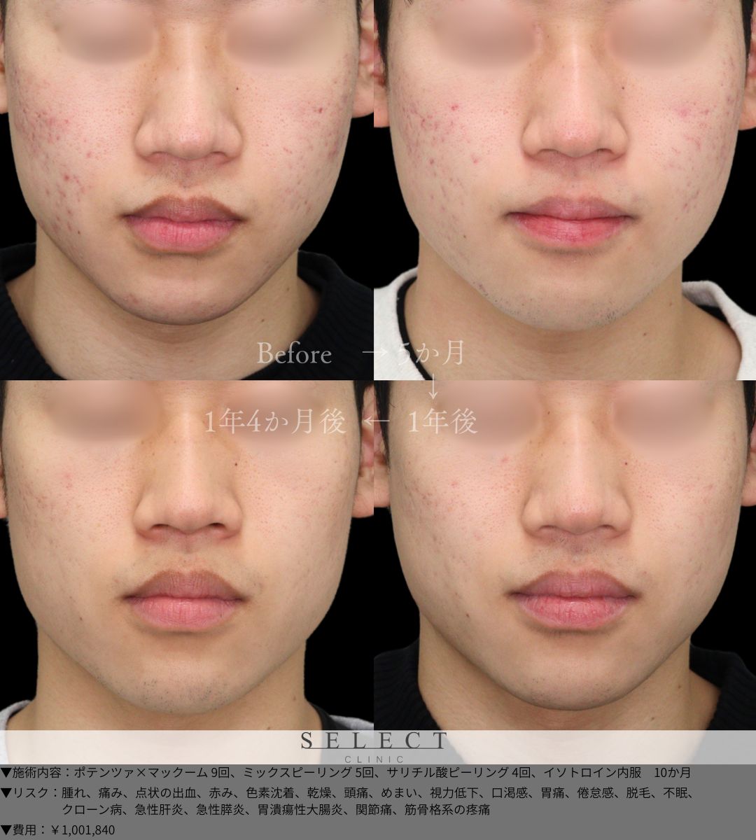 ポテンツァ×マックーム9回 ミックスピーリング5回 サリチル酸ピーリング4回 イソトロイン内服　10か月