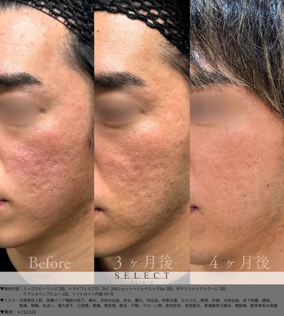 ミックスピーリング2回 トライフィルプロ（Dr）200ショット＋ジュベルック3cc2回 ポテンツァ×マックーム2回 ケアシスペップビュー2回 イソトロイン内服4か月