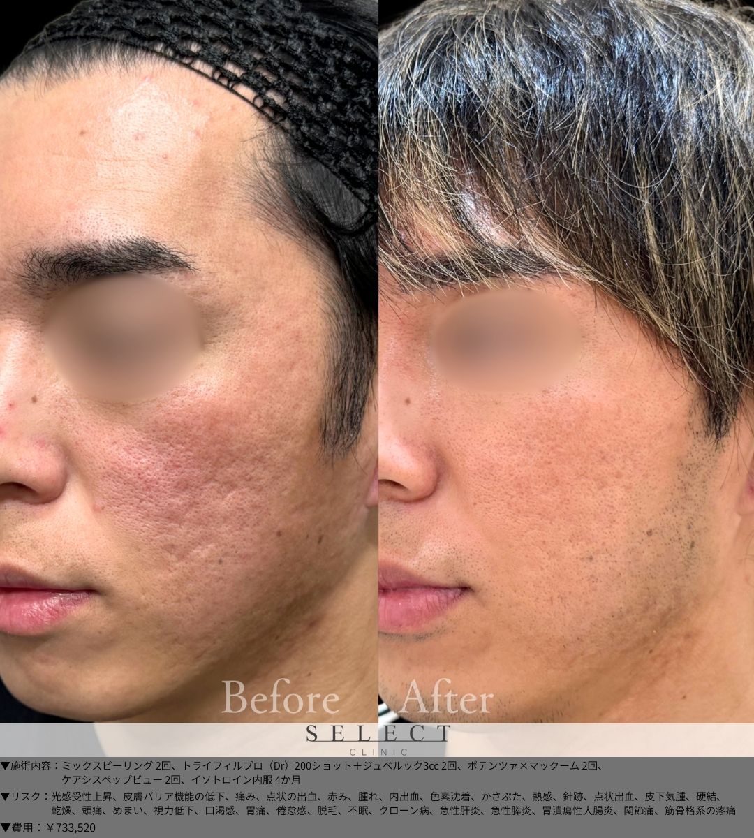 ミックスピーリング2回 トライフィルプロ（Dr）200ショット＋ジュベルック3cc2回 ポテンツァ×マックーム2回 ケアシスペップビュー2回 イソトロイン内服4か月