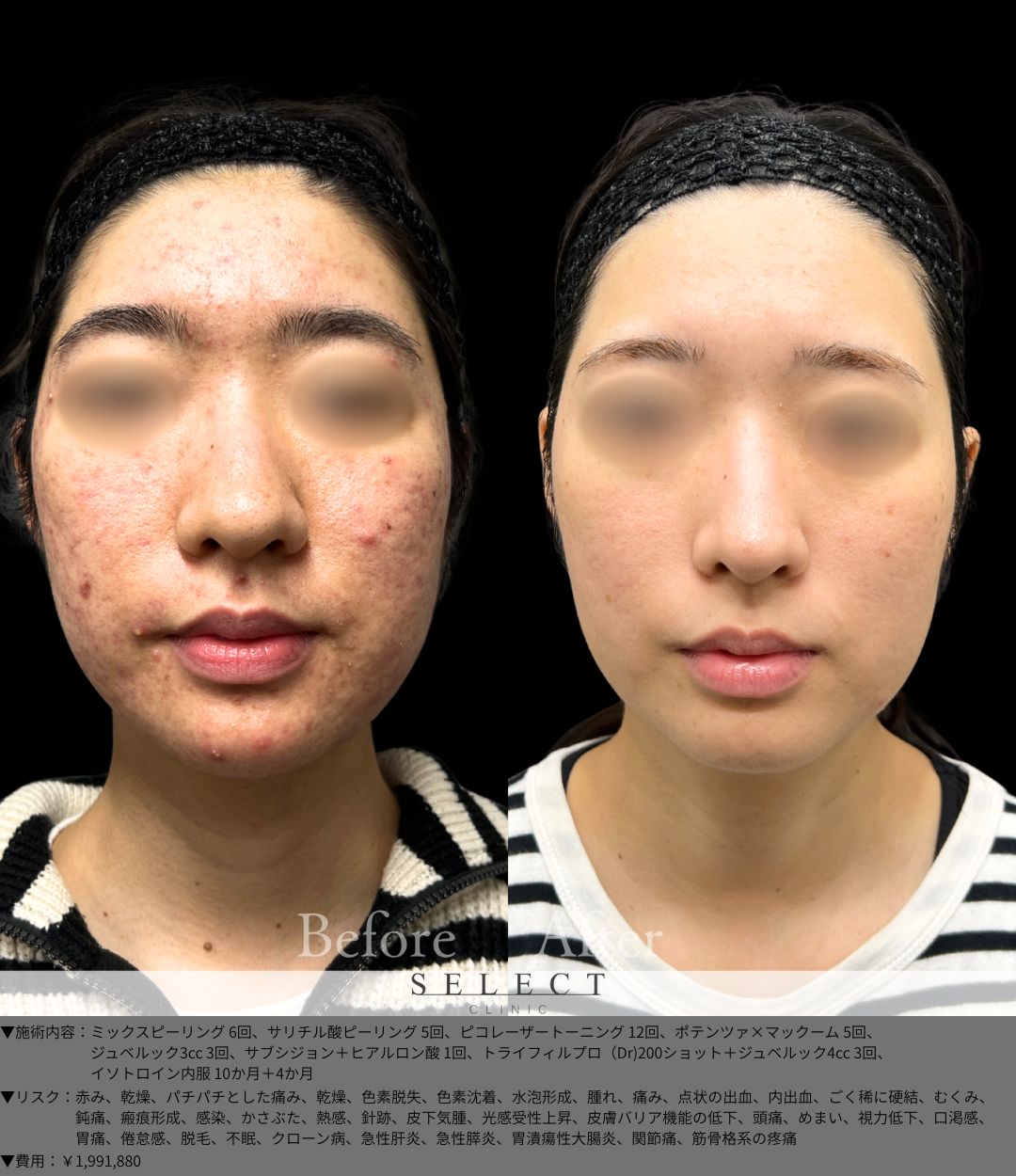 ミックスピーリング6回 サリチル酸ピーリング5回 ピコレーザートーニング12回 ポテンツァ×マックーム5回 ジュベルック3cc3回 サブシジョン＋ヒアルロン酸1回 トライフィルプロ（Dr)200ショット＋ジュベルック4cc3回 イソトロイン内服10か月＋4か月