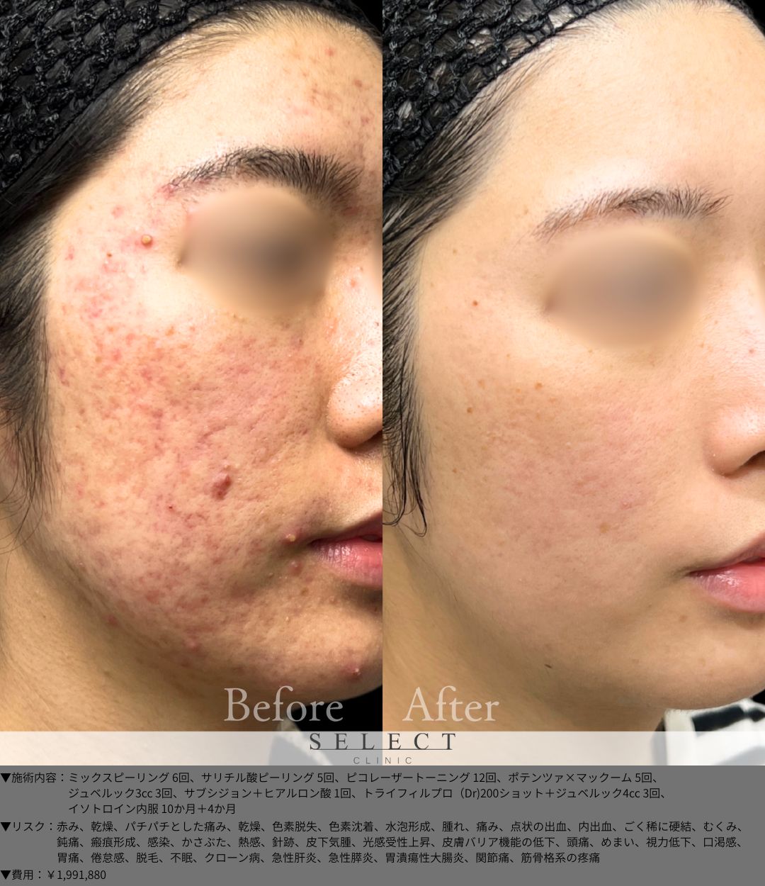 ミックスピーリング6回 サリチル酸ピーリング5回 ピコレーザートーニング12回 ポテンツァ×マックーム5回 ジュベルック3cc3回 サブシジョン＋ヒアルロン酸1回 トライフィルプロ（Dr)200ショット＋ジュベルック4cc3回 イソトロイン内服10か月＋4か月