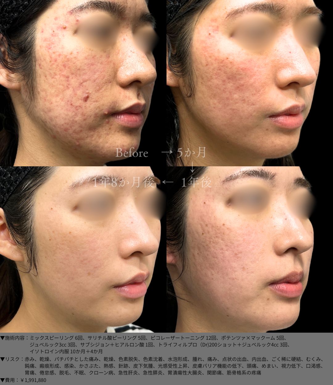 ミックスピーリング6回 サリチル酸ピーリング5回 ピコレーザートーニング12回 ポテンツァ×マックーム5回 ジュベルック3cc3回 サブシジョン＋ヒアルロン酸1回 トライフィルプロ（Dr)200ショット＋ジュベルック4cc3回 イソトロイン内服10か月＋4か月