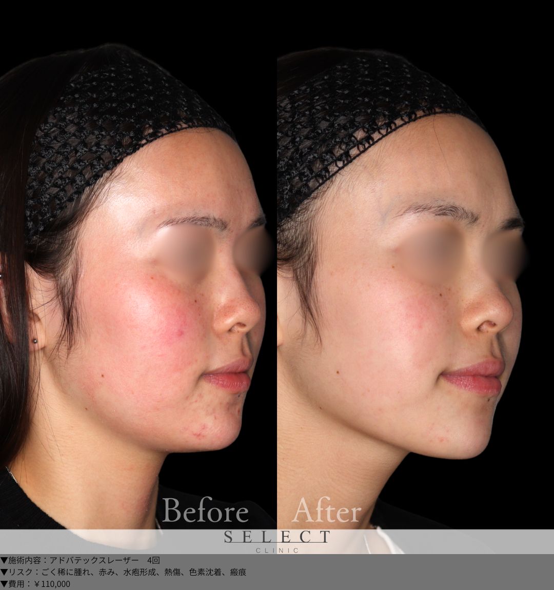 アドバテックスレーザー4回