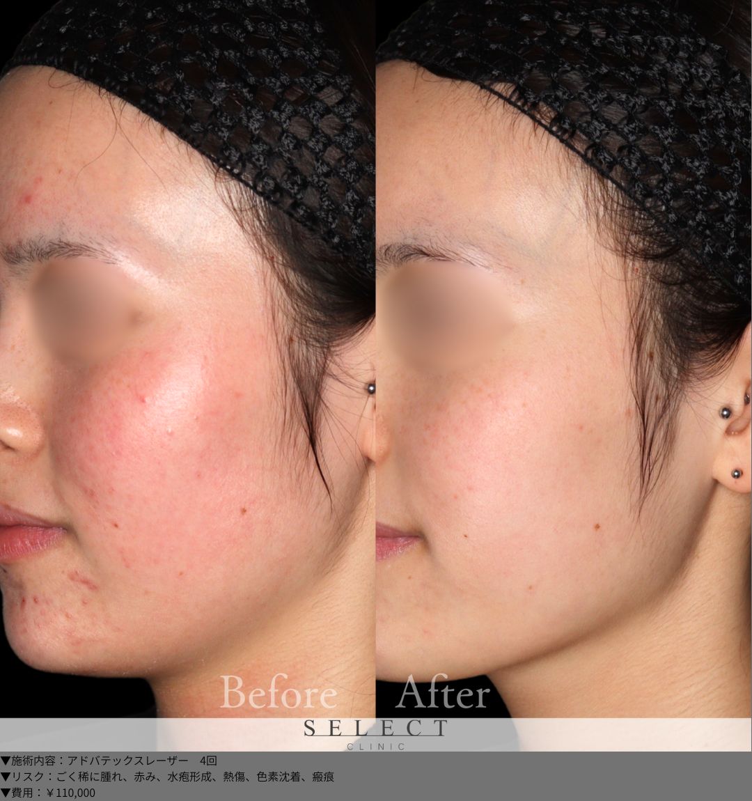 アドバテックスレーザー4回