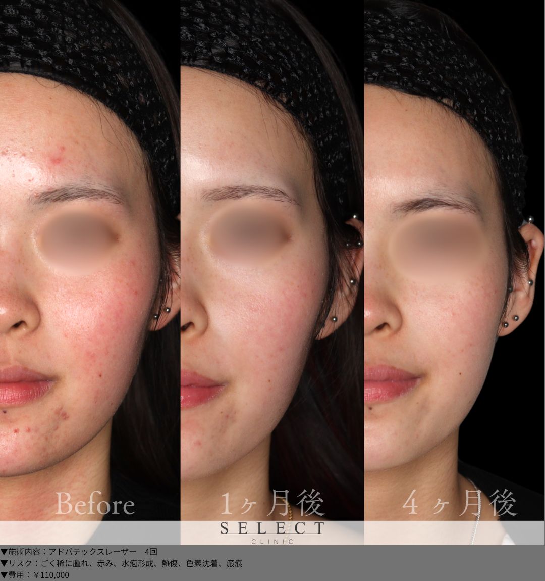 アドバテックスレーザー4回