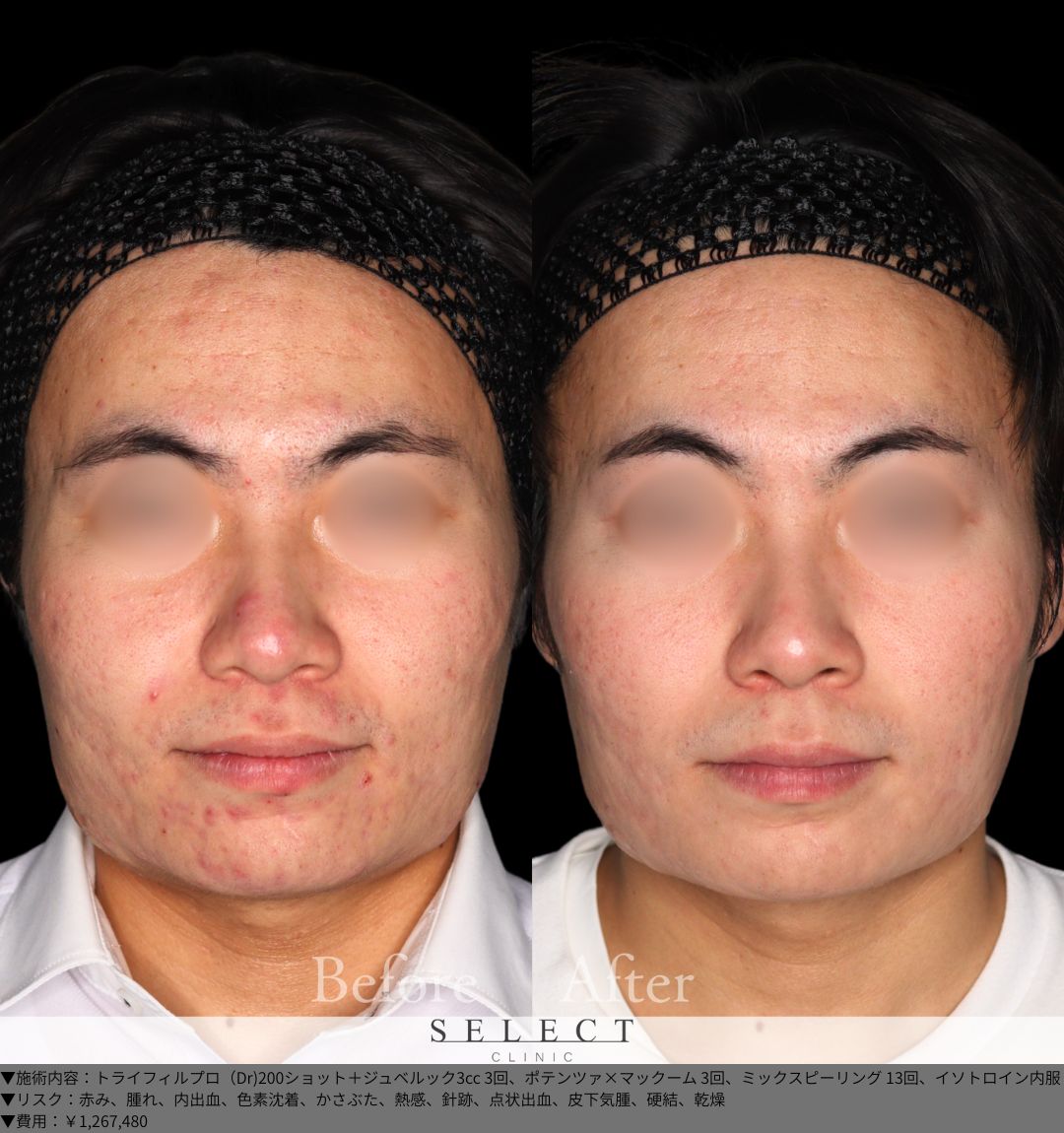 トライフィルプロ（Dr)200ショット＋ジュベルック3cc3回 ポテンツァ×マックーム3回 ミックスピーリング13回 イソトロイン内服