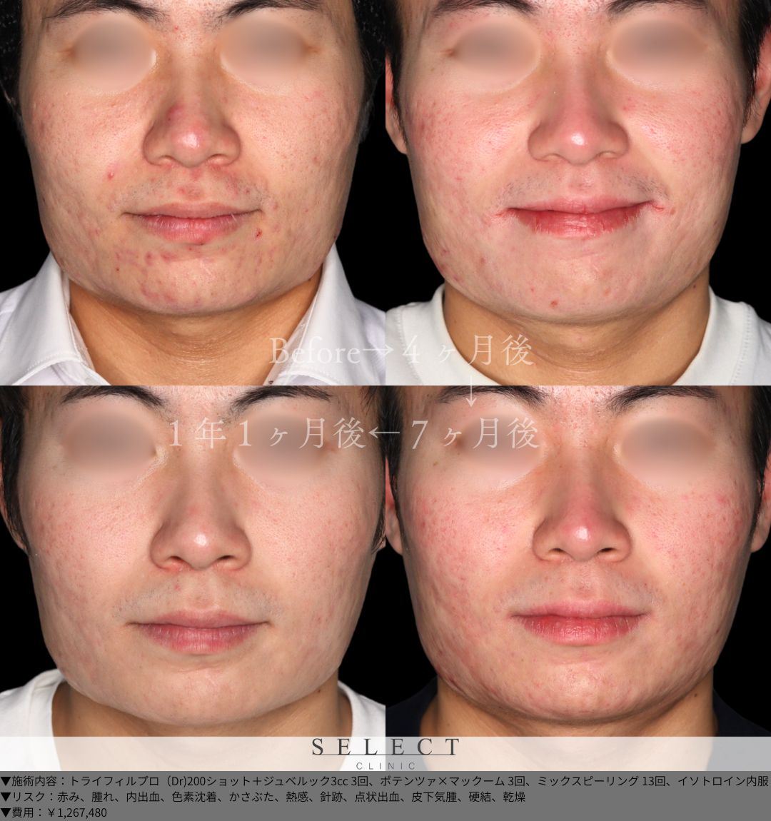 トライフィルプロ（Dr)200ショット＋ジュベルック3cc3回 ポテンツァ×マックーム3回 ミックスピーリング13回 イソトロイン内服