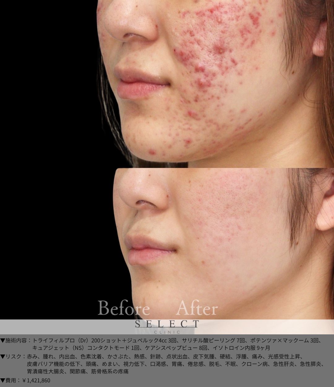 トライフィルプロ（Dr）200ショット＋ジュベルック4cc3回 サリチル酸ピーリング7回 ポテンツァ×マックーム3回 キュアジェット（NS）コンタクトモード1回 ケアシスペップビュー8回 イソトロイン内服9ヶ月