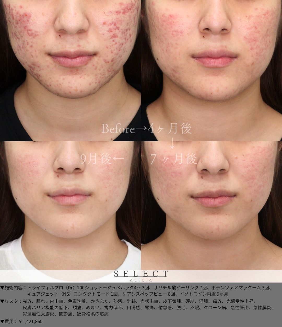 トライフィルプロ（Dr）200ショット＋ジュベルック4cc3回 サリチル酸ピーリング7回 ポテンツァ×マックーム3回 キュアジェット（NS）コンタクトモード1回 ケアシスペップビュー8回 イソトロイン内服9ヶ月