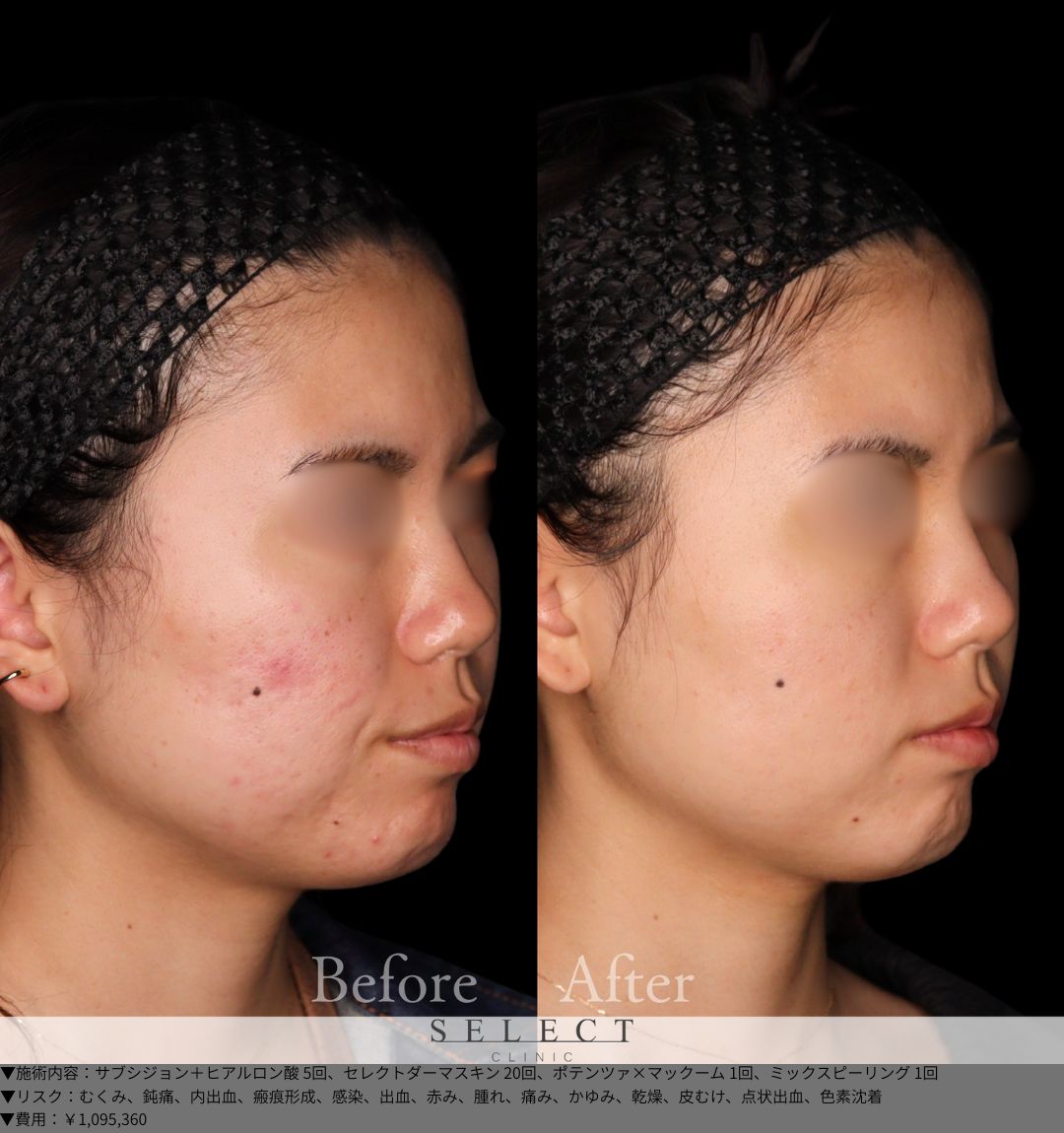 サブシジョン＋ヒアルロン酸5回 セレクトダーマスキン20回 ポテンツァ×マックーム1回 ミックスピーリング1回