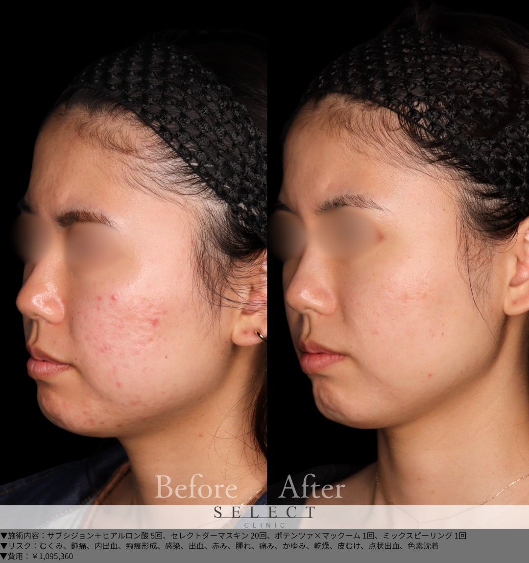 サブシジョン＋ヒアルロン酸5回 セレクトダーマスキン20回 ポテンツァ×マックーム1回 ミックスピーリング1回