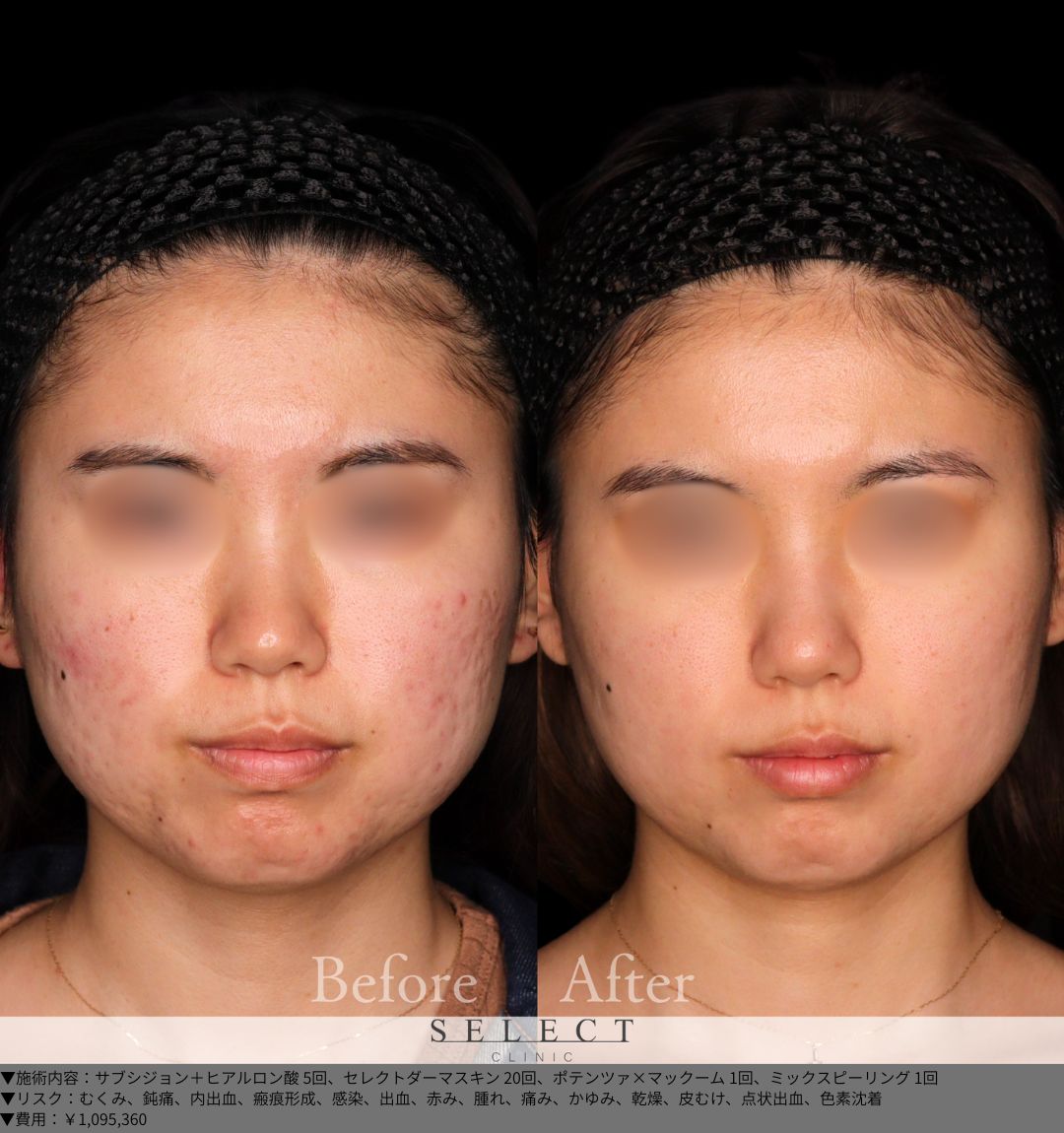 サブシジョン＋ヒアルロン酸5回 セレクトダーマスキン20回 ポテンツァ×マックーム1回 ミックスピーリング1回